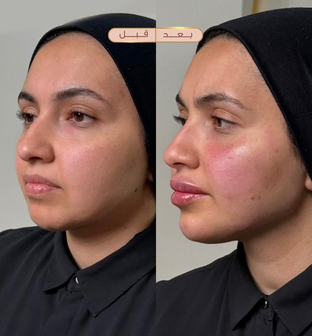 محفزات الكولاجين (الشد المائي)