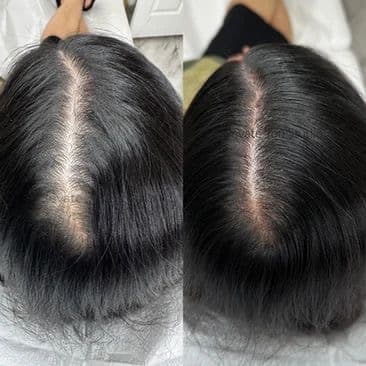 أكسوزوم لشعر 