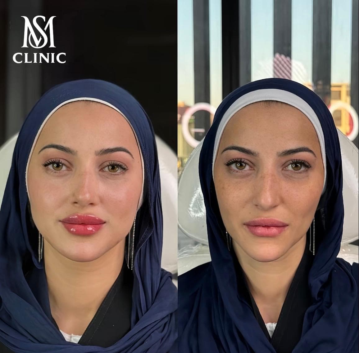 فيلر الشفاه والوجه